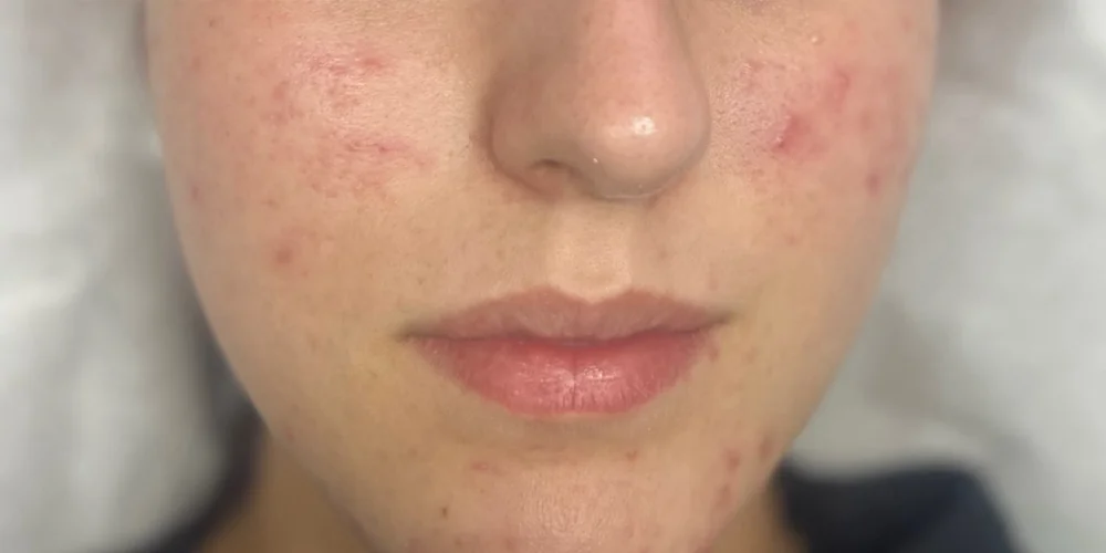 Microneedling — sichtbar beruhigtes Aknebild — nachher