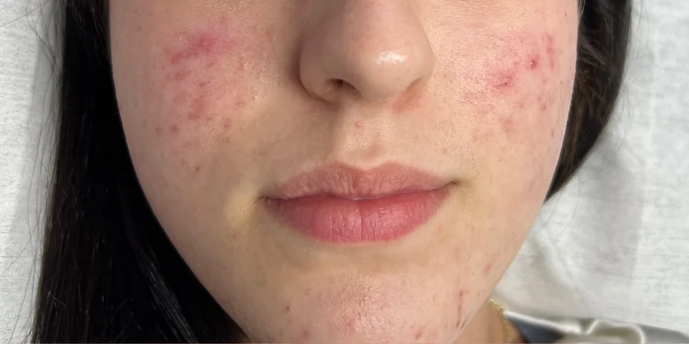 Microneedling — sichtbar beruhigtes Aknebild — vorher