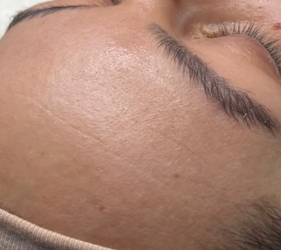Microneedling — reduzierte Fältchen — nachher