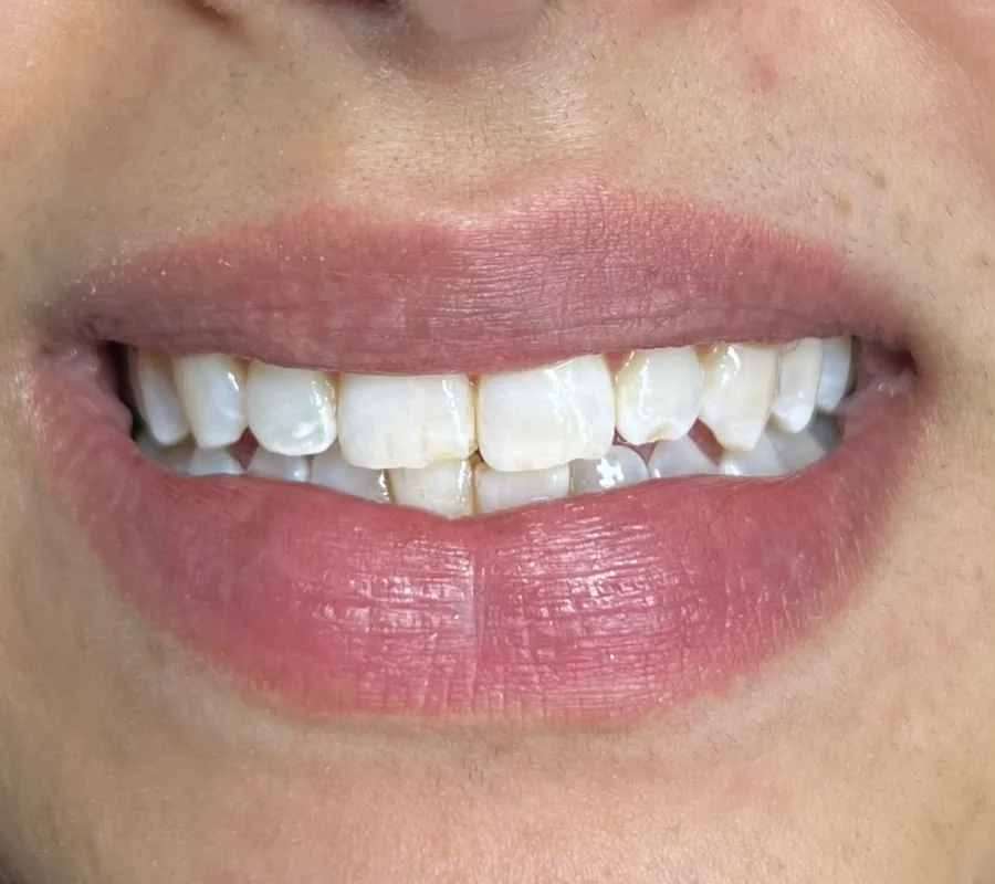 Zahnbleaching — strahlenderes Lächeln — nachher