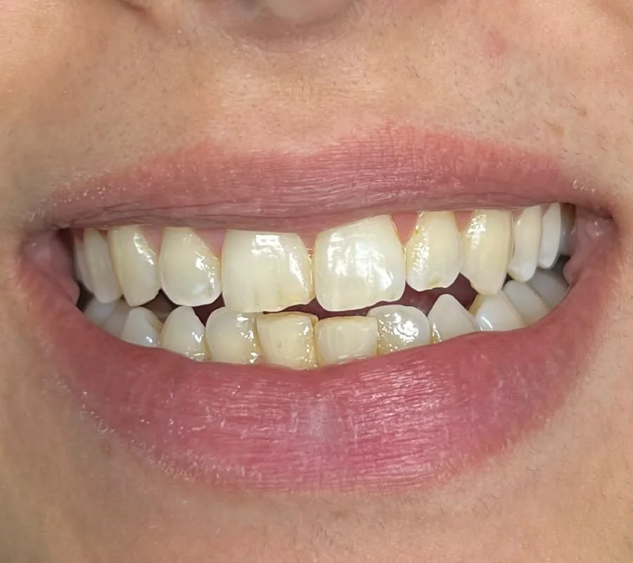 Zahnbleaching — strahlenderes Lächeln — vorher