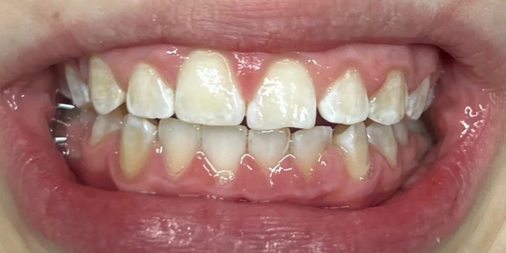 Zahnbleaching — sichtbar hellere Zähne — nachher