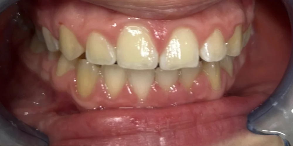 Zahnbleaching — sichtbar hellere Zähne — vorher