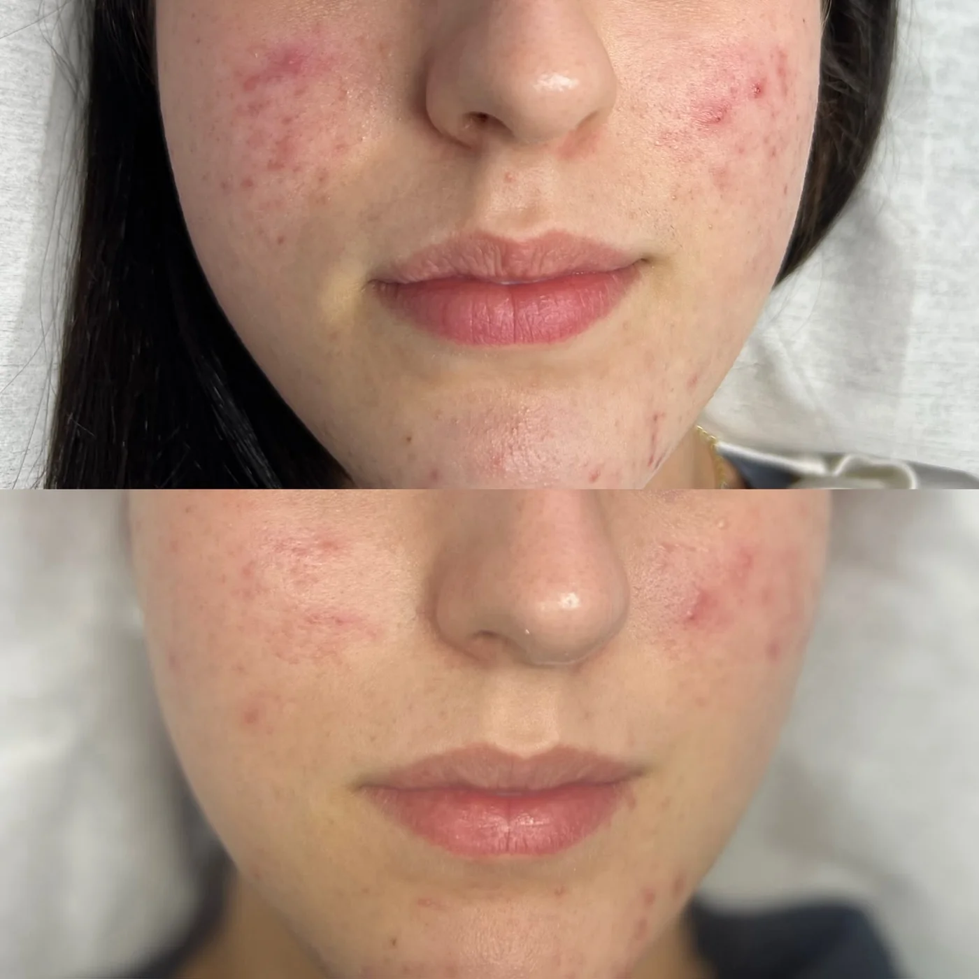 Microneedling Ergebnis — Vorher und Nachher