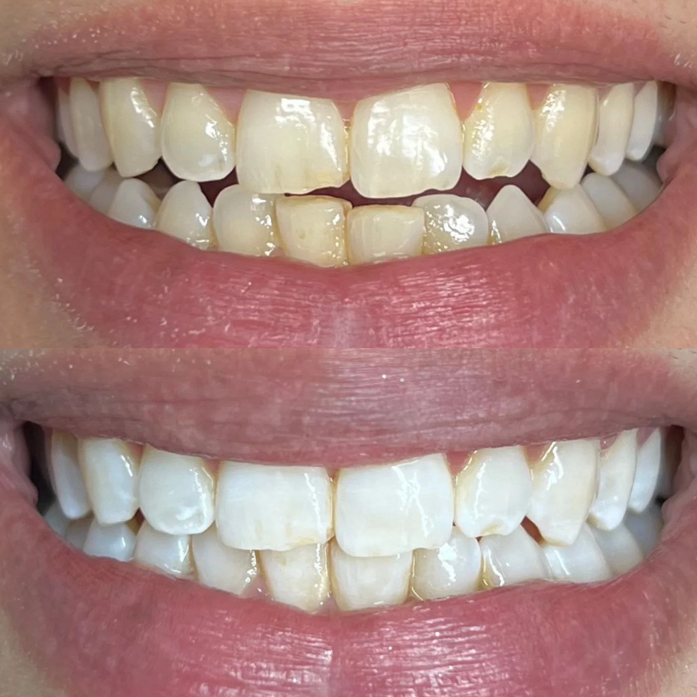 Zahnbleaching Ergebnis — Vorher und Nachher