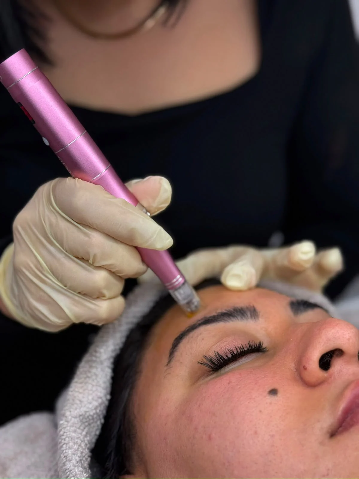 Microneedling Behandlung