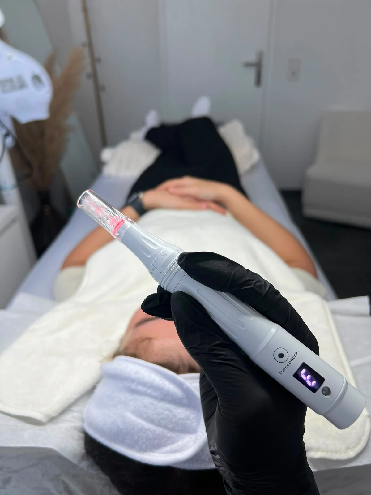 Microneedling Behandlung mit Cure Concept Pen