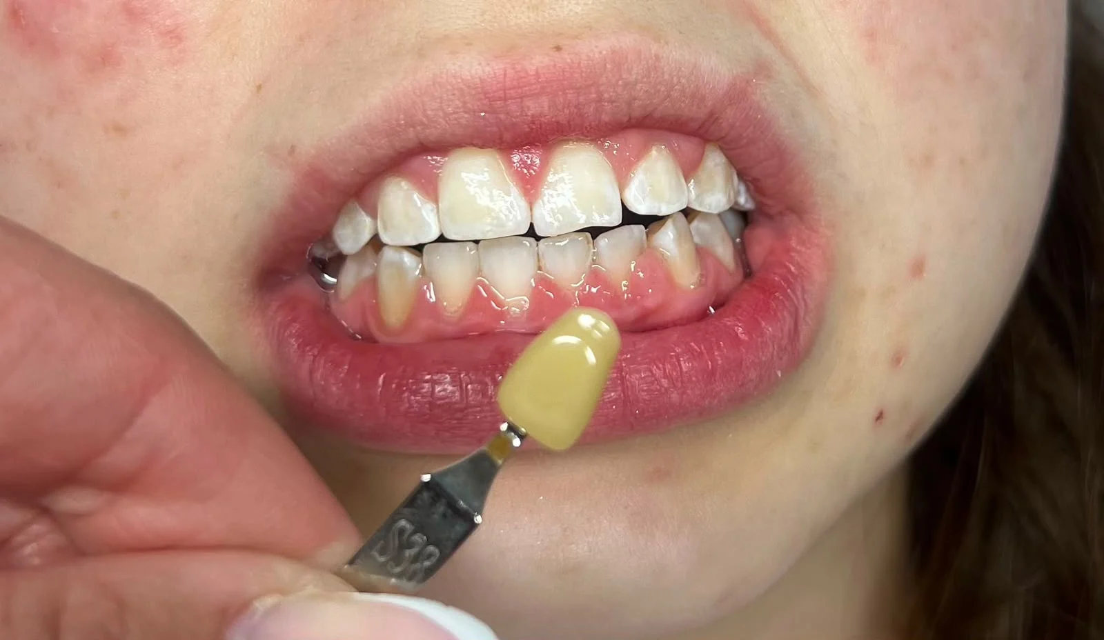Zahnbleaching Farbbestimmung