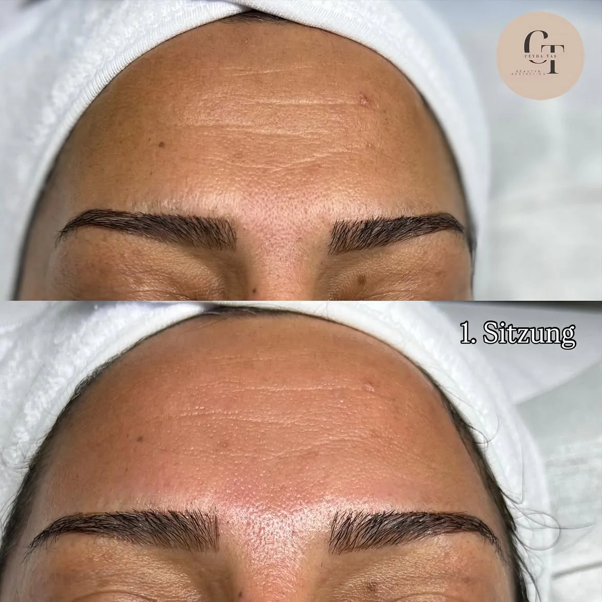 Microneedling Ergebnis
